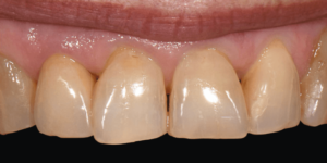 VITA Akzent Plus Chroma Stains-szel árnyalt fogpótlás