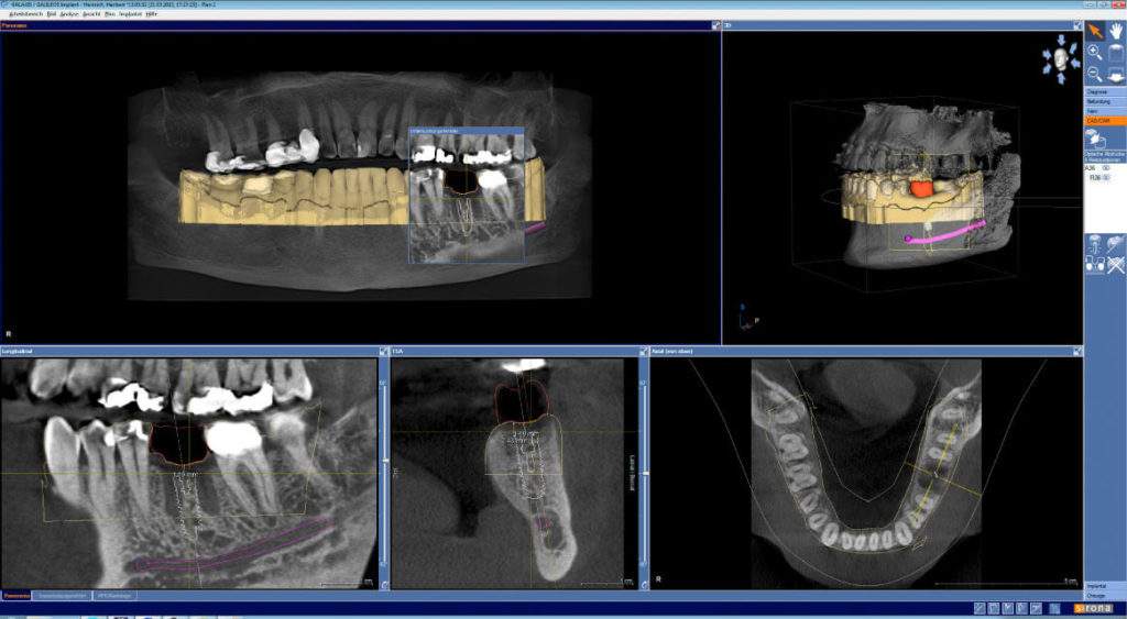 Implantátumos pótlás tervezése