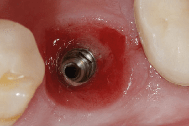 Implantátumos fogpótlás kezdeti állapota