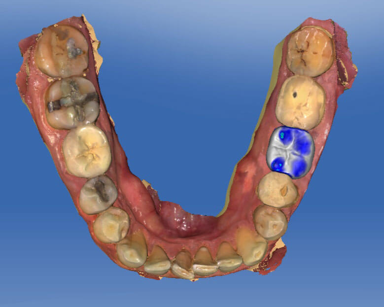 Implantátumos pótlás tervezés digitálisan