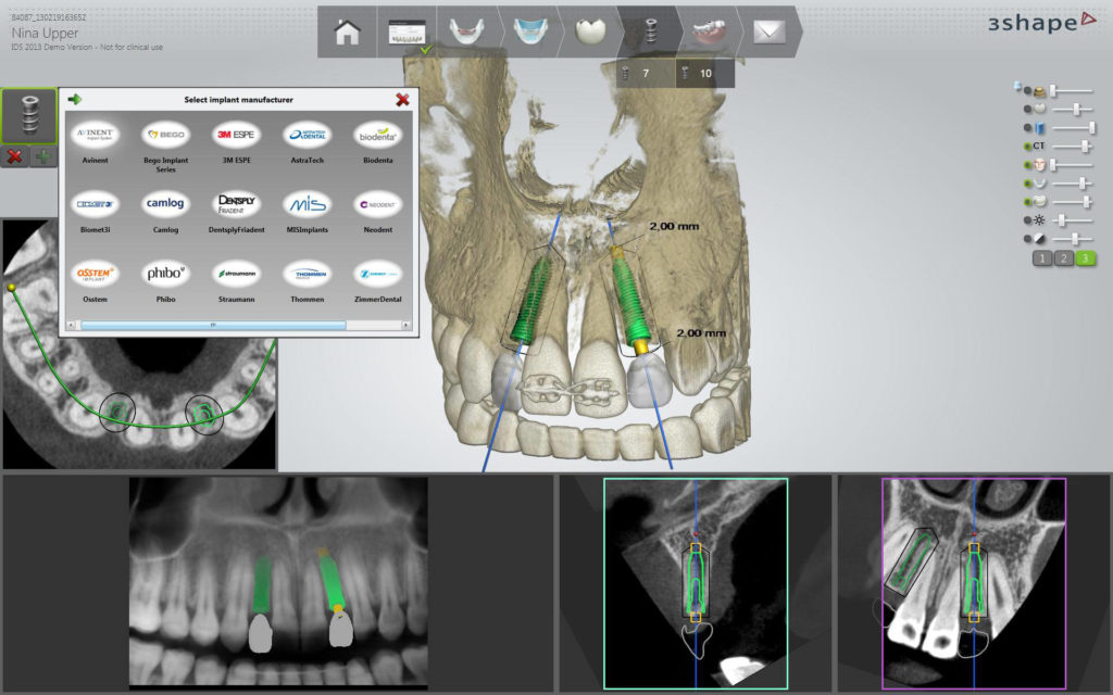 3Shape Implant Studio szoftver implantátum típusválasztó ablak