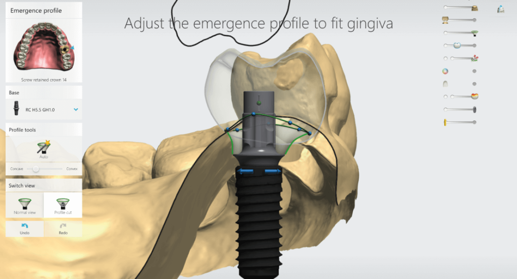 Fogászati implantátum tervezése 3Shape Implant Studio szoftverrel