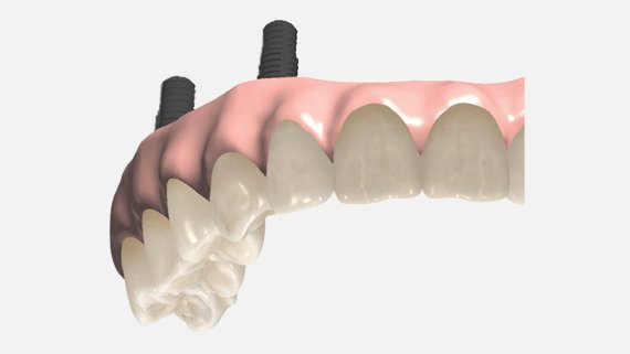 Gingiva implantátumos hidakhoz