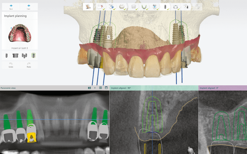 Implant Studio tervezőszoftver
