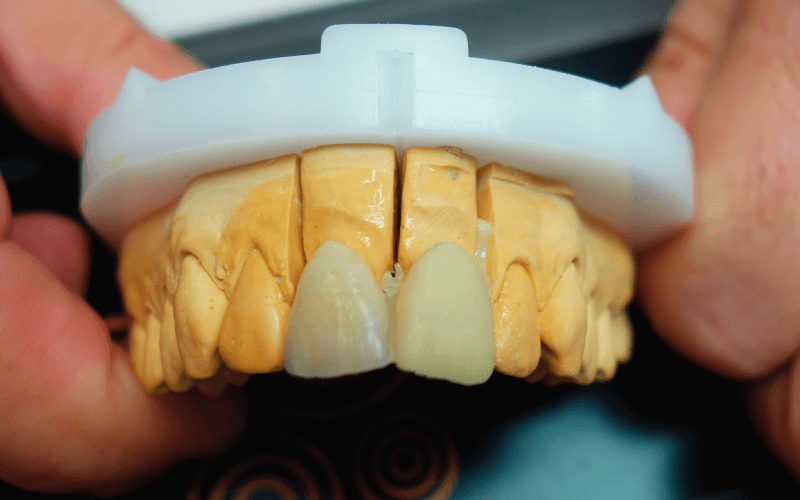 Beinjektált nyers VITA VM LC kompozit dentin korona a fémkerámia korona mellett