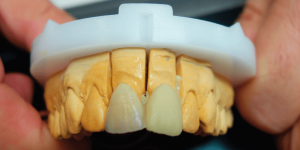 Beinjektált nyers kompozit dentin korona a fémkerámia korona mellett