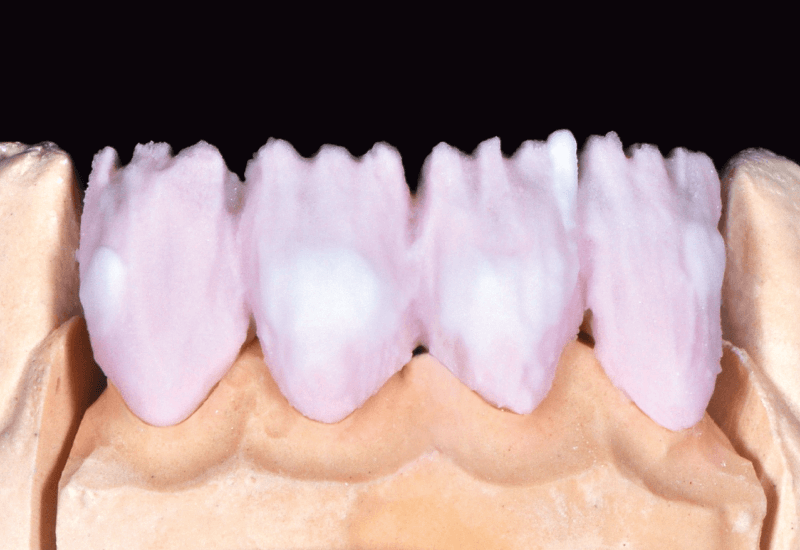 A DENTINE A3 –ból felrakott középső területeket OPAL TRANSLUCENT opal neutral masszával borítottuk