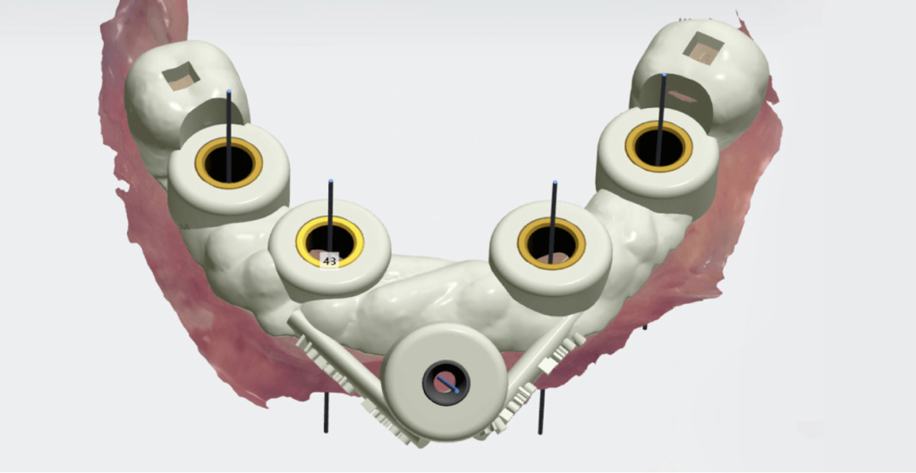 3D fúrósablon tervezés 3shape Implant Studio szoftverrel