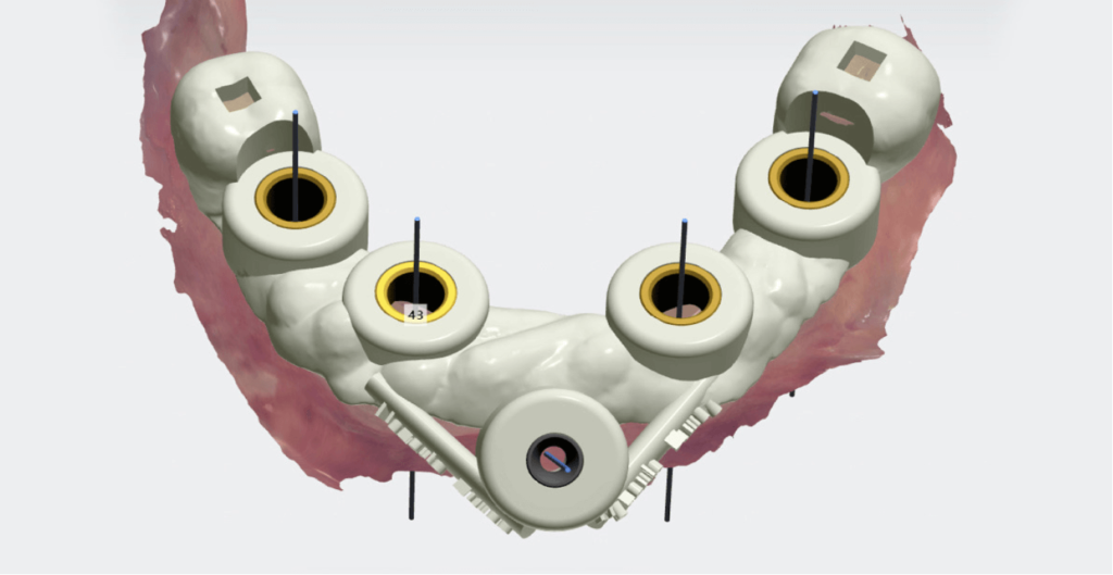 3D fúrósablon tervezés 3shape Implant Studio szoftverrel