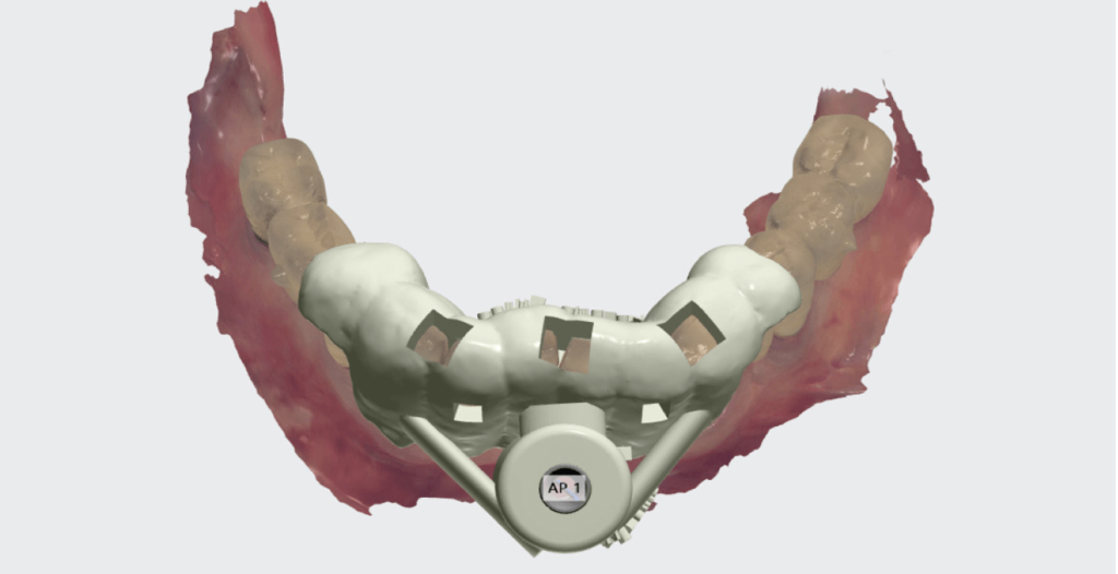 3D fúrósablon tervezés 3shape Implant Studio szoftverrel