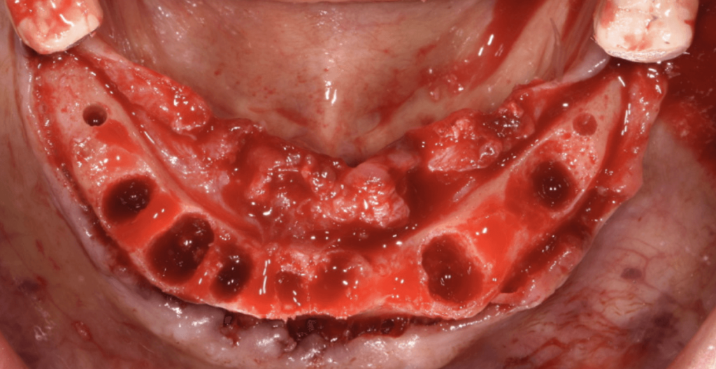 Elkészült irányított implantátum rögzítő osteotómia