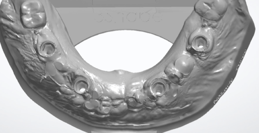 implantátumos modell tervezés Bio-Horizon könyvtár használatával