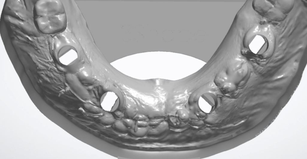 implantátumos modell tervezés Bio-Horizon könyvtár használatával