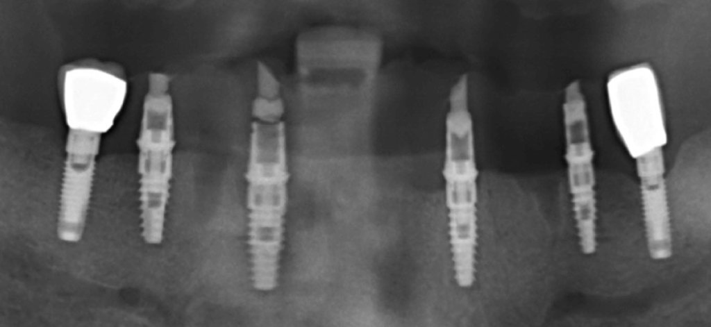 A digitális röntgenfelvétel mutatja az implantátumok szögeit és az elhelyezésüket