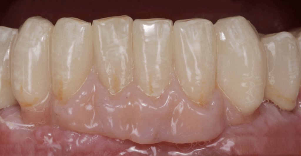 Végső kép az alsó implantátumos hídról a páciens szájában