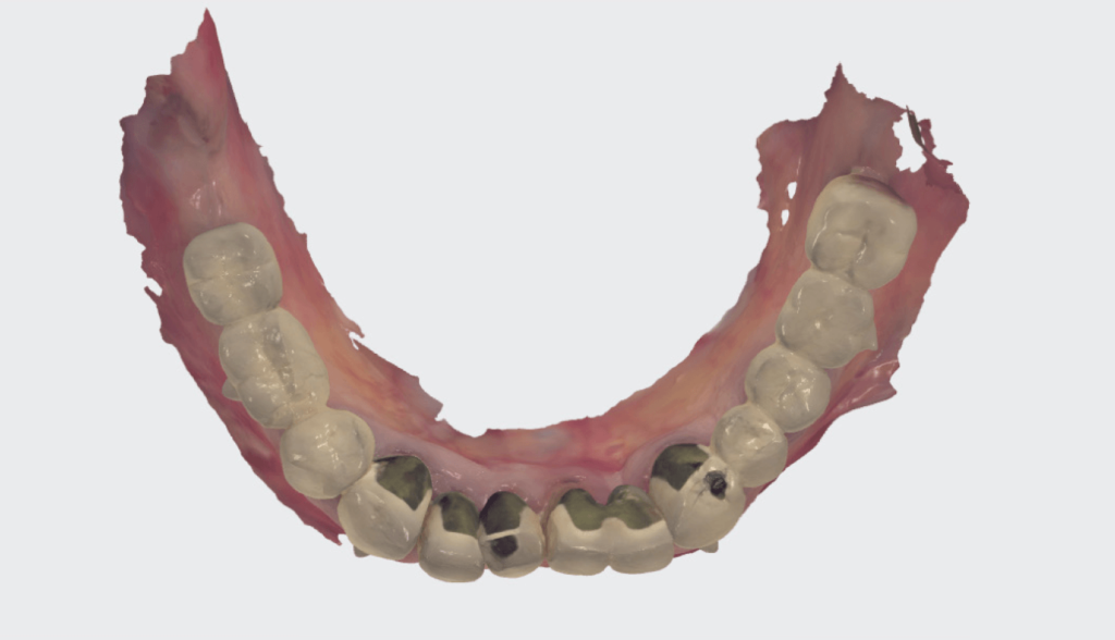 Virtuális fogeltávolítás a digitális implantátum tervezéshez – rágófelszíni nézet