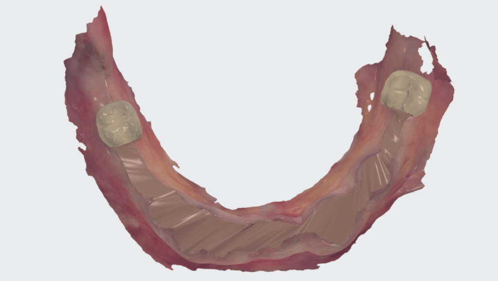 Virtuális fogeltávolítás a digitális implantátum tervezéshez – rágófelszíni nézet