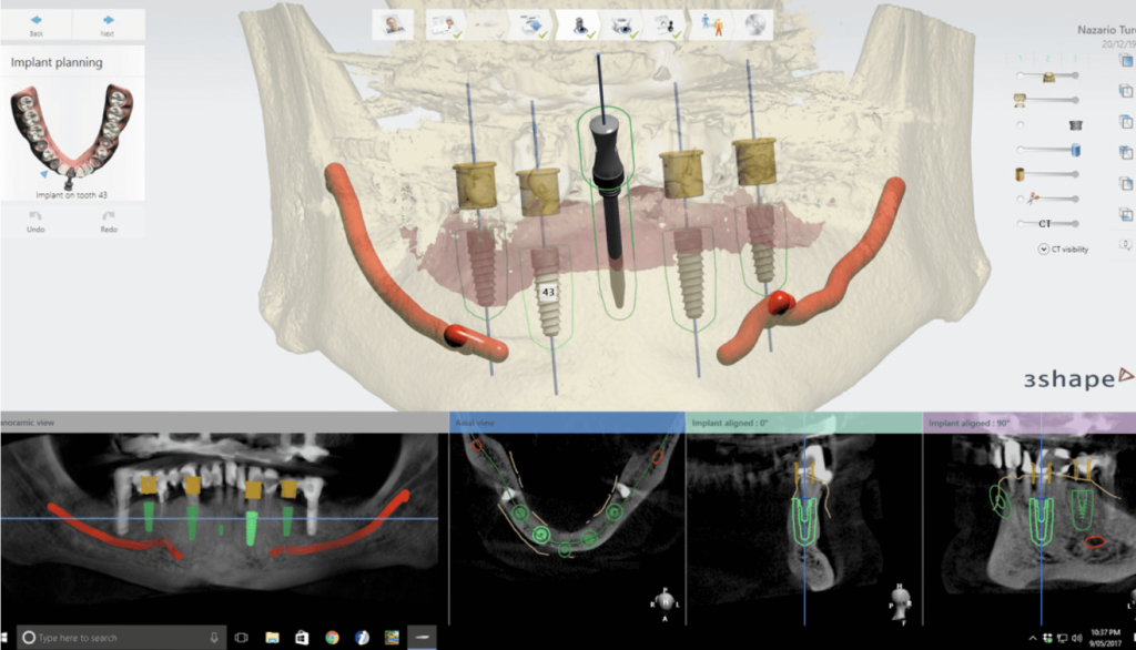 Virtuális implantáció tervezés a 3shape Implant Studo szoftverével)