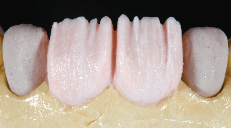 Anatómikusan redukált dentinmag, DENTINE A1 réteggel bevonva.
