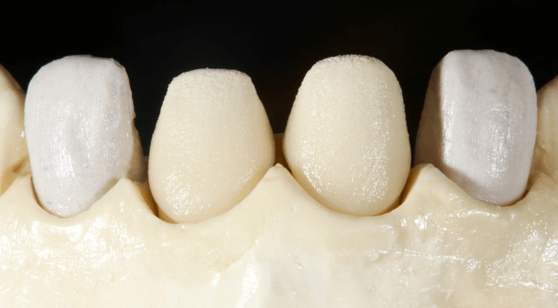 Az első dentinégetés VITA VMK Master LUMINARY 1 (fehér) és 4 (világos barnás-narancs) masszákkal.