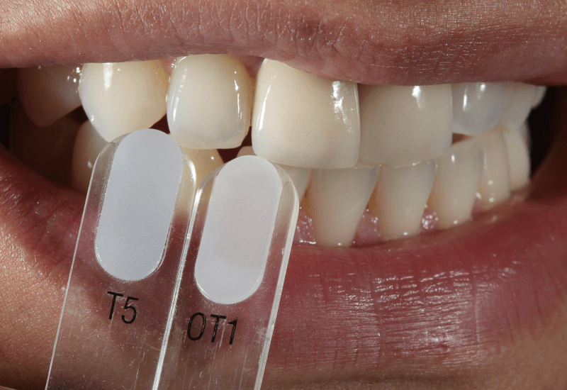 A transzlucens színárnyalatok meghatározása VITA VMK Master TRANSLUCENT színmintákkal.